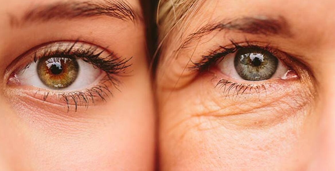 Segni esterni dell'invecchiamento della pelle intorno agli occhi in due donne di età diverse