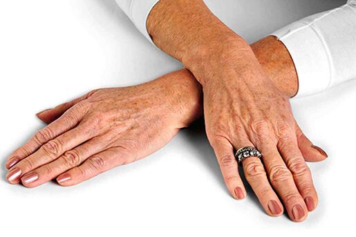 Pelle delle mani con cambiamenti legati all'età che richiedono l'uso di tecniche di ringiovanimento