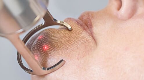 Il corso della procedura per il ringiovanimento della pelle del viso con laser frazionario