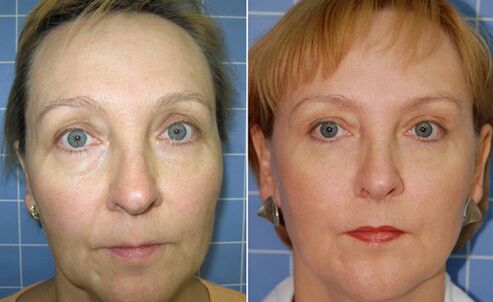 Prima e dopo il ringiovanimento del viso con laser frazionato