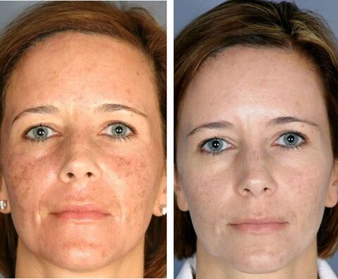 Prima e dopo la termolisi facciale frazionata